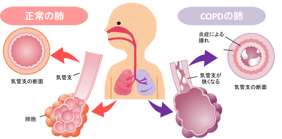 正常な肺とＣＯＰＤの肺の比較図